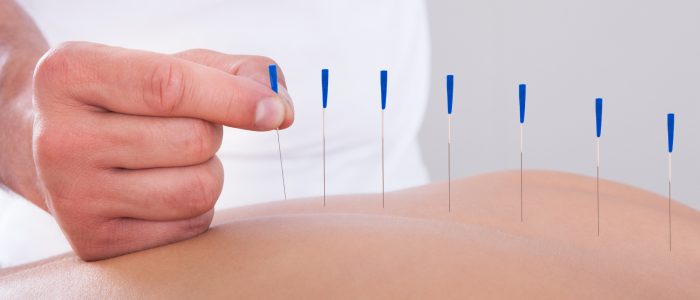 Woman Receiving An Acupuncture Therapy Young Beautiful Woman In An Acupuncture Therapy In A Spa Center